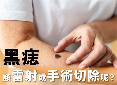 陰莖 黑痣|手術切除還是其他方法？陰莖黑痣、陰囊和包皮痣的處理方式